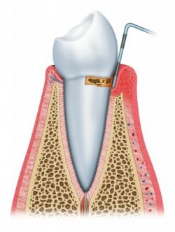 photo_dental_-_tackling_dental_plaque_10-15-2012