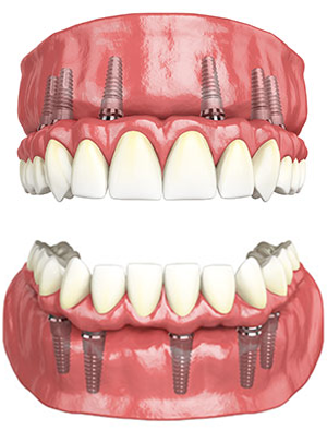 Hybridge dental implants full arch upper and lower