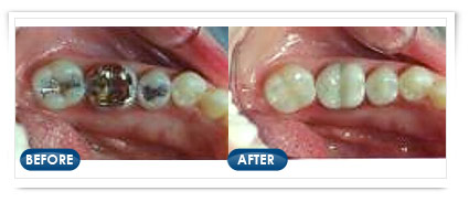 remove and replace metal fillings with white fillings