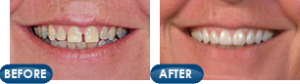 Rotem Dental Care patient Gearhardt before and after photos