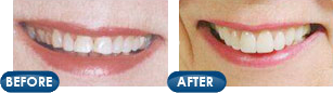 Before and After cosmetic dentistry treatment at Rotem Dental Care