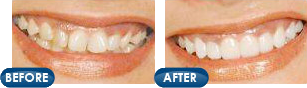 Before and after photos at Toms River cosmetic dentist