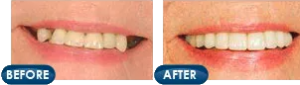 Rotem Dental Care dentures patient review