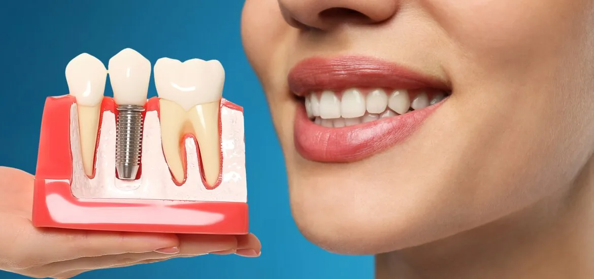 Young woman with beautiful smile and dentist holding educational model of dental implant on blue background,