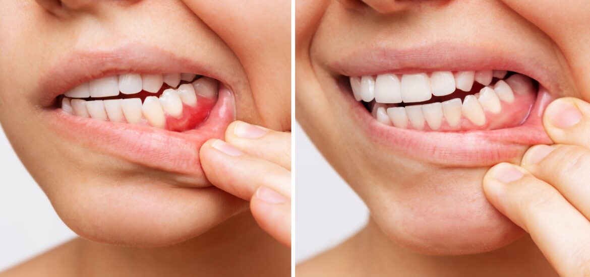 side by side closeup showing the stages of gum disease