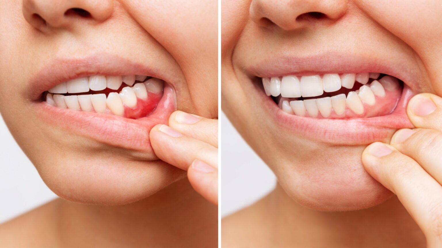 side by side closeup showing the stages of gum disease