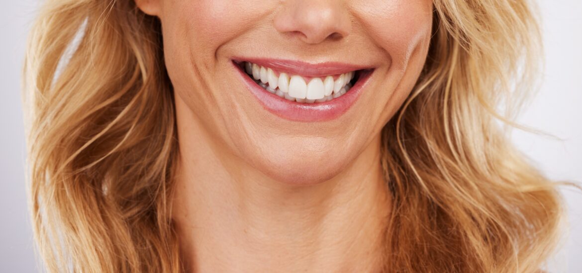 closeup of the lower half of a woman's face, dental veneers