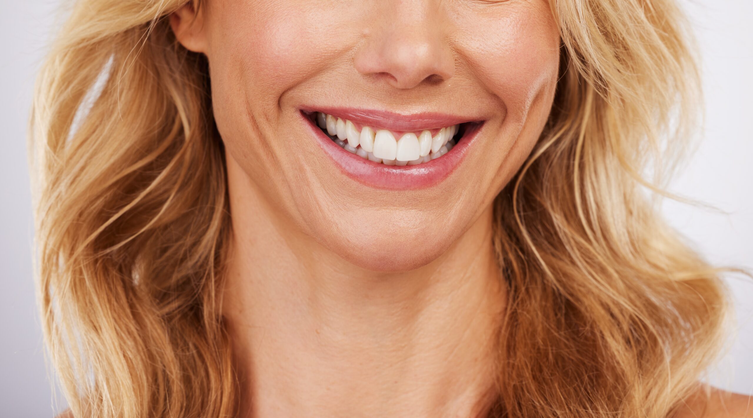 closeup of the lower half of a woman's face, dental veneers