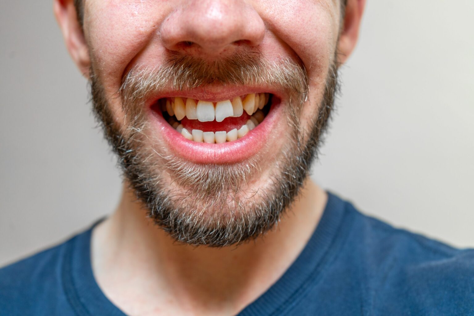 closeup of a man in a blue shirt with a chipped front tooth