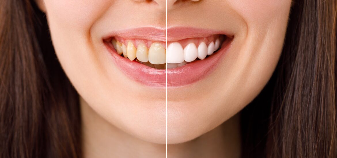 before and after professional teeth whitening treatment