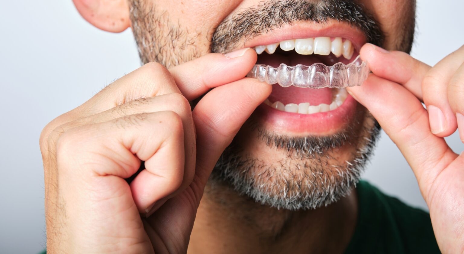 unrecognizable dark-haired man with a beard putting in Invisalign