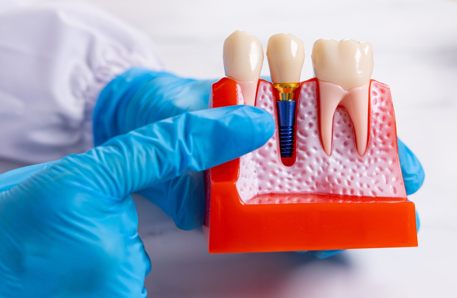 closeup of a dentist in blue gloves pointing to an implant model